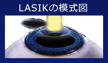 LASIK�̖͎��}